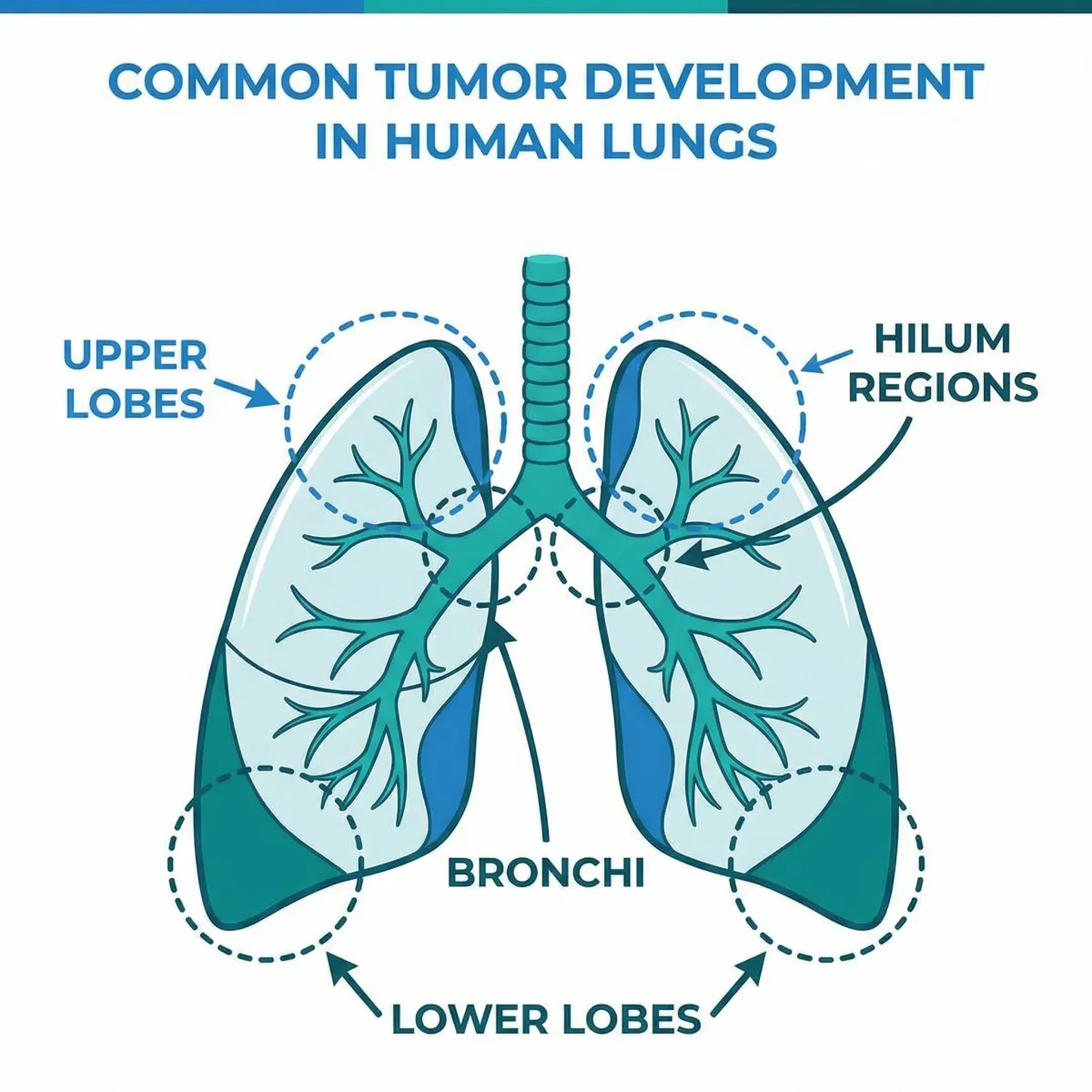 Medical illustration showing common locations where lung tumors develop and surrounding chest anatomy