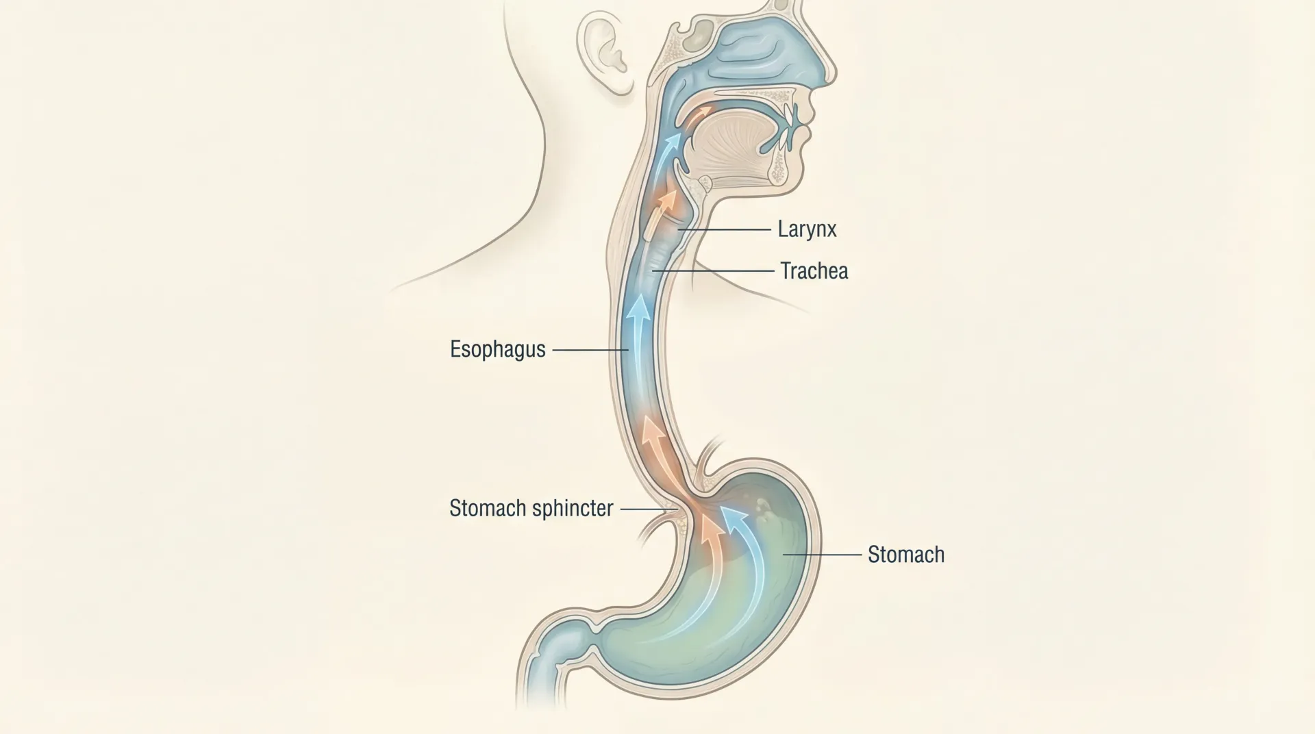 Cross-sectional medical illustration of the throat, esophagus, and stomach showing reflux reaching the larynx.