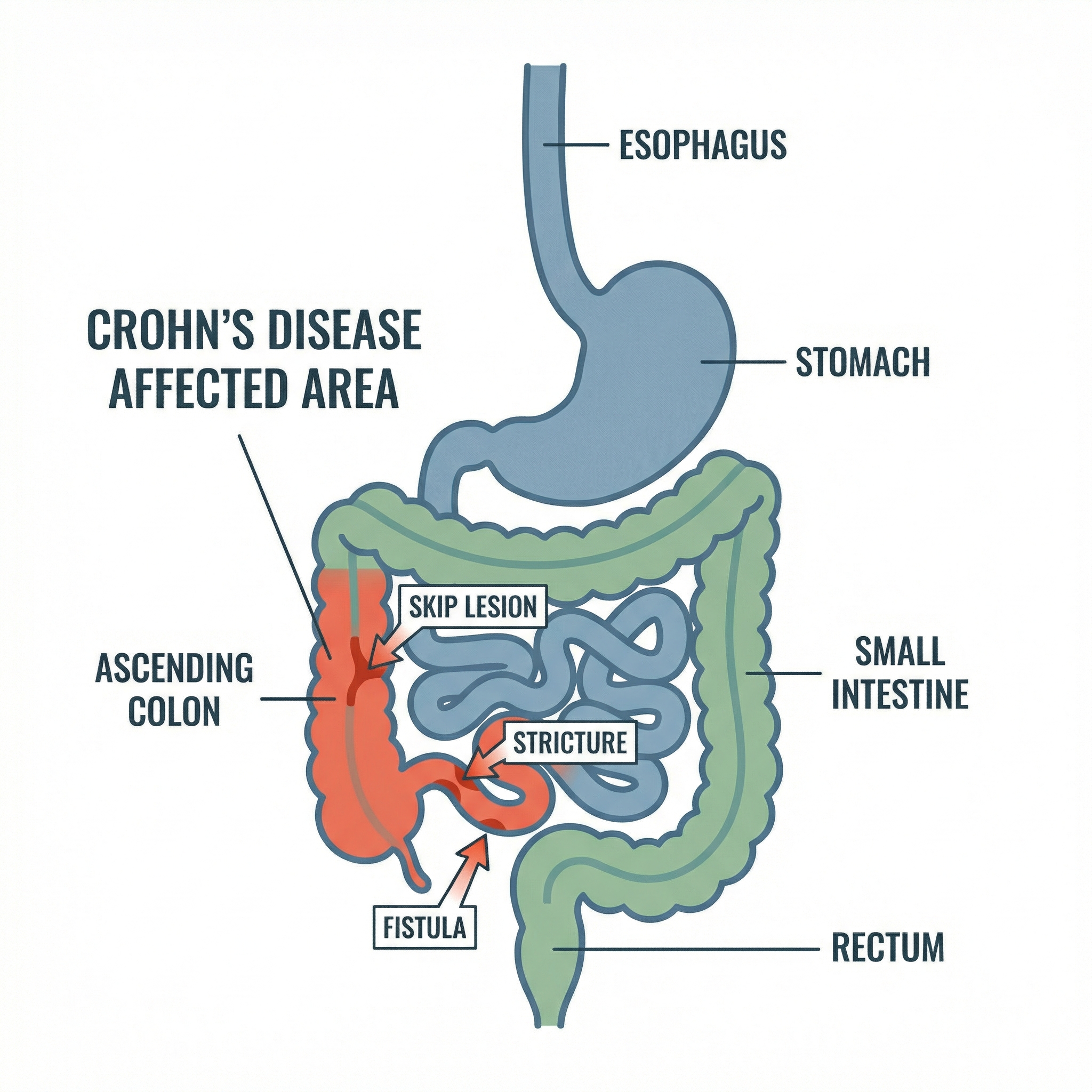 Infographic showing the gastrointestinal tract with labeled regions most commonly affected by Crohn's disease including terminal ileum and colon