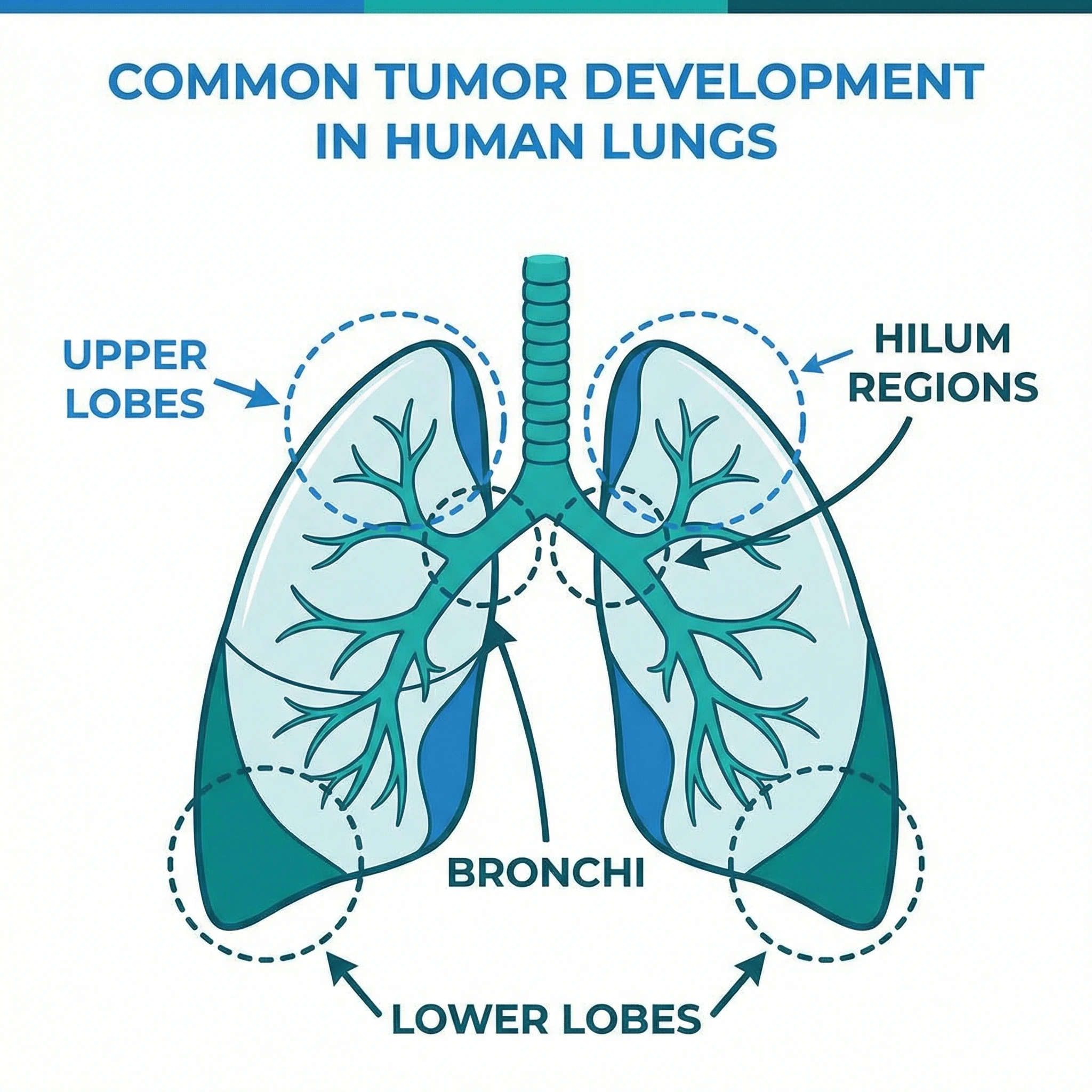 Medical illustration showing common locations where lung tumors develop and surrounding chest anatomy